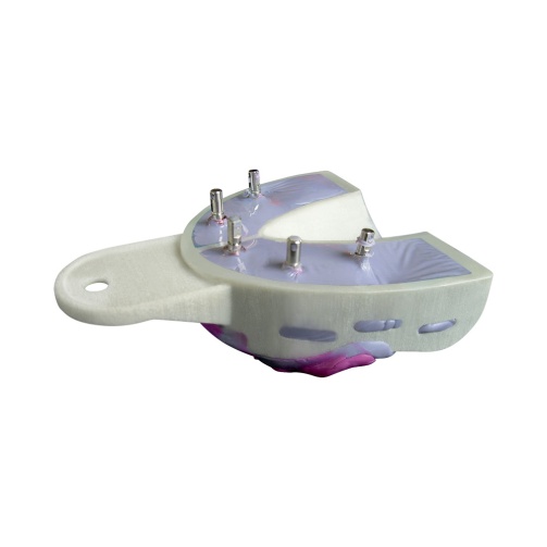 Miratray Implant - Intro Kit 3x horní (velikost 1,2,3), 3x dolní (velikost 1,2,3)